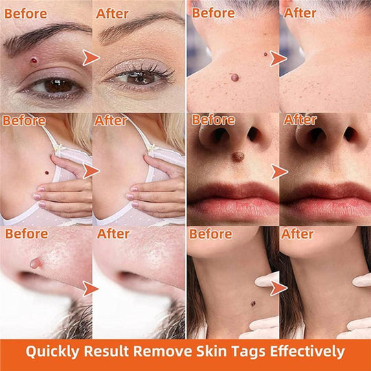 Auto Skin Tag Remover Painless - beumoonshop