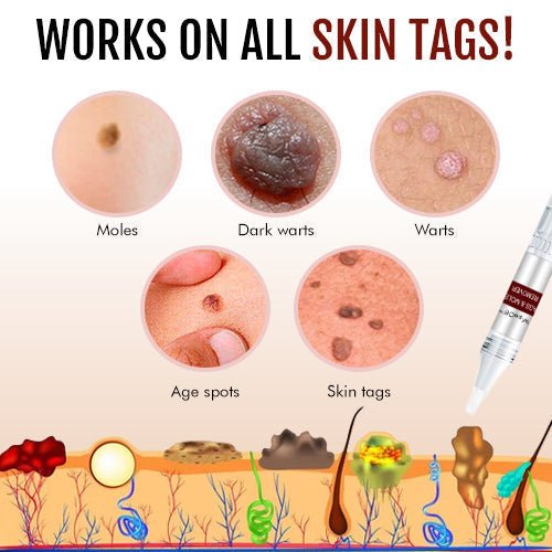 🔥Last Day Promotion 65% OFF🔥𝗤𝗩𝗖 recommends Tags & Moles Remover - beumoonshop