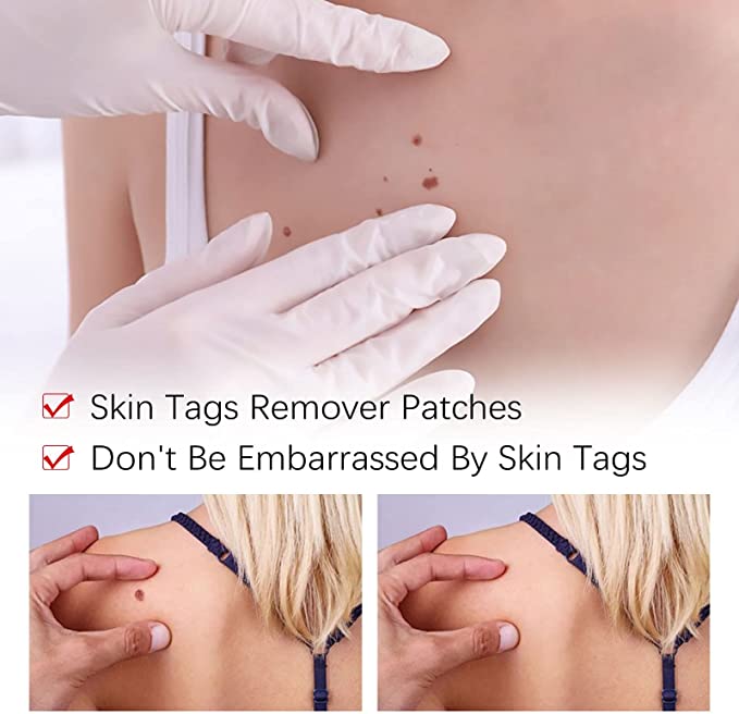 🔥Last Day Promotion 65% OFF🔥𝗤𝗩𝗖 recommends Tags & Moles Remover - beumoonshop